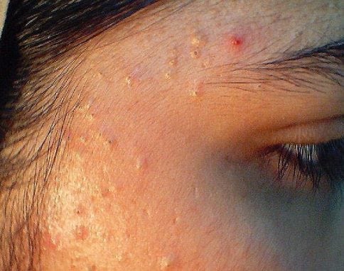 Sfaturi care te ajuta in lupta contra acneei